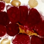 Νικήθηκε η λευχαιμία και μάλιστα ακόμα και στο τελικό στάδιο