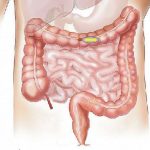 Ορισμένα βακτήρια του παχέος εντέρου πιθανώς βάζουν το «χεράκι» τους για να προκληθεί καρκίνος