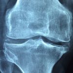 Παγκόσμια Ημέρα Οστεοπόρωσης σήμερα: Ανησυχητικά χαμηλή η πρόσληψη ασβεστίου σε πολλές χώρες, αλλά όχι στην Ελλάδα, σύμφωνα με μελέτη