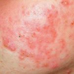 Η παχυσαρκία αυξάνει τον κίνδυνο για ροδόχρου νόσο (ροζάκια) στο πρόσωπο των γυναικών