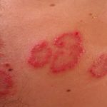 Υγεία: Ψωρίαση & συμμόρφωση στη θεραπεία: Το κλειδί για ένα καθαρό δέρμα