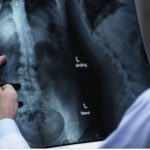 Η έγκαιρη έναρξη θεραπείας στην Πολλαπλή Σκλήρυνση οδηγεί σε βελτιωμένα αποτελέσματα