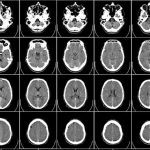 Νέο σύστημα τεχνητής νοημοσύνης κάνει ορθές νευρολογικές διαγνώσεις-εξπρές πολύ πιο γρήγορα και από γιατρό