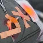 Επιστήμονες στις ΗΠΑ βρήκαν τρόπο για πρώτη φορά να μετατρέπουν ανοιχτά τραύματα απευθείας σε νέο υγιές δέρμα