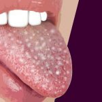 Δεκατρία ύποπτα σημάδια για τον καρκίνο του στόματος
