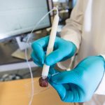 Πρωτοποριακό χειρουργικό «πενάκι» διακρίνει με ακρίβεια τον καρκίνο από τον υγιή ιστό μέσα σε λίγα δευτερόλεπτα