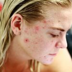 Περισσότερο φως στο γενετικό υπόβαθρο της ακμής ρίχνει μια νέα μελέτη (με ελληνική συμμετοχή)