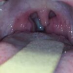 Βασικές ενδείξεις αφαίρεσης αμυγδάλων στα παιδιά σύμφωνα με τους Ω.Ρ.Λ