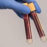 Υγεία: Ένα νέο τεστ αίματος μπορεί να ανιχνεύσει ίχνη Αλτσχάιμερ χρόνια πριν τα πρώτα συμπτώματα της νόσου