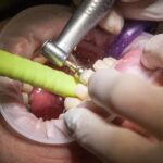 Υγεία: Η απώλεια δοντιών σχετίζεται με αυξημένο κίνδυνο για άνοια, σύμφωνα με αμερικανική έρευνα