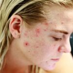 Υγεία: Σχεδόν οι μισοί Ευρωπαίοι έχουν τουλάχιστον ένα δερματολογικό πρόβλημα