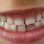 Υγεία: Η καλή φροντίδα των δοντιών μπορεί να κάνει καλό στον εγκέφαλο