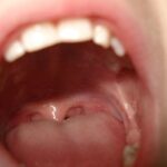 Υγεία: Στοματική κοιλότητα, το «εύκολο θύμα» των σύγχρονων ογκολογικών θεραπειών