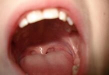 Υγεία: Στοματική κοιλότητα, το «εύκολο θύμα» των σύγχρονων ογκολογικών θεραπειών